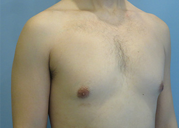 Gynecomastia Before & After case 4