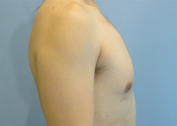 Gynecomastia Before & After case 4