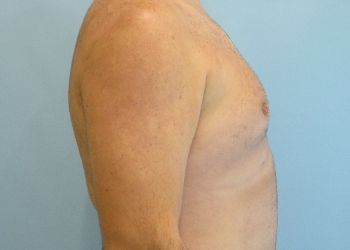 Gynecomastia Before & After case 5