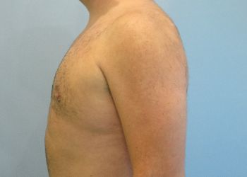 Gynecomastia Before & After case 5