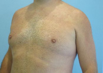 Gynecomastia Before & After case 5