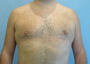 Gynecomastia Before & After case 5