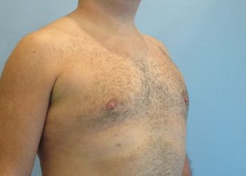 Gynecomastia Before & AfterGynecomastia Before & After case 5