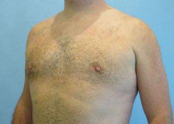Gynecomastia Before & After case 5