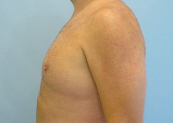 Gynecomastia Before & After case 5