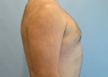 Gynecomastia Before & After case 5