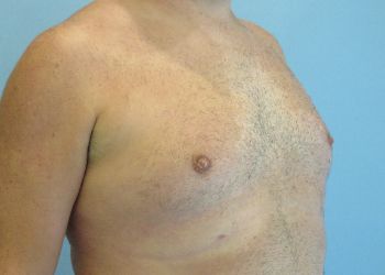 Gynecomastia Before & After case 5