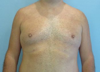 Gynecomastia Before & After case 5