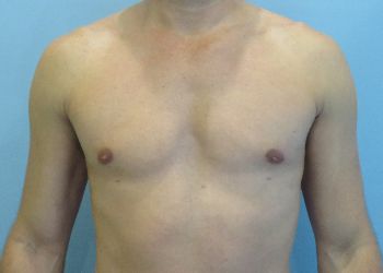 Gynecomastia Before & After case 6