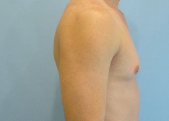Gynecomastia Before & After case 6