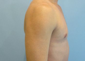 Gynecomastia Before & After case 6