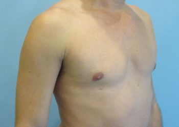 Gynecomastia Before & After case 6
