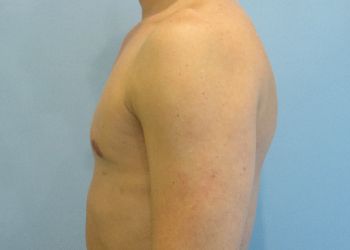 Gynecomastia Before & After case 6