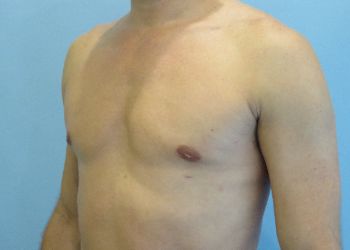 Gynecomastia Before & After case 6