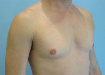 Gynecomastia Before & After case 6
