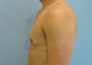 Gynecomastia Before & After case 6