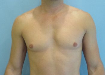 Gynecomastia Before & After case 6