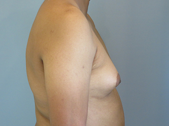 Gynecomastia Before & After case 7