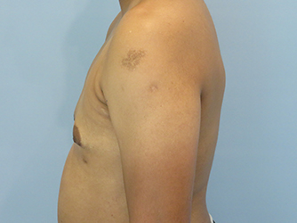 Gynecomastia Before & After case 7