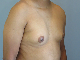 Gynecomastia Before & After case 7
