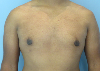 Gynecomastia Before & After case 9