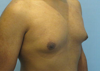 Gynecomastia Before & After case 9