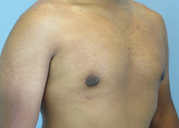 Gynecomastia Before & After case 9