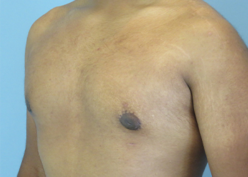 Gynecomastia Before & After case 9