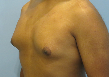 Gynecomastia Before & After case 9