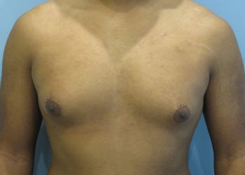 Gynecomastia Before & After case 9