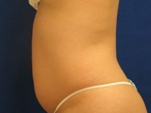 Smart Liposuction Before & After case 15