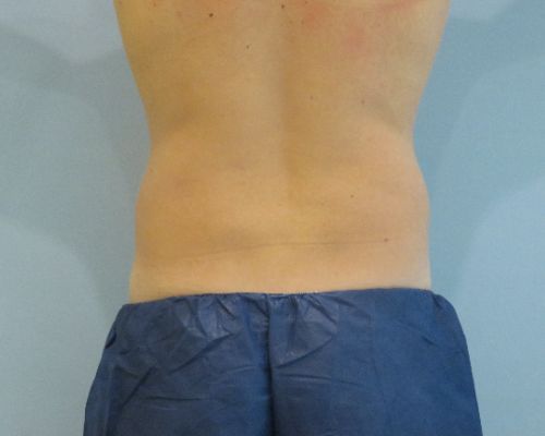 Smart Liposuction Before & After case 1