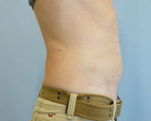 Smart Liposuction Before & After case 1