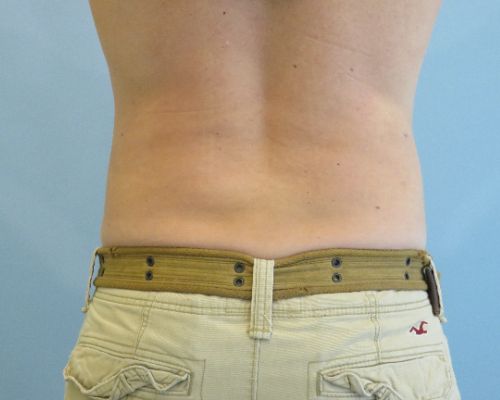 Smart Liposuction Before & After case 1