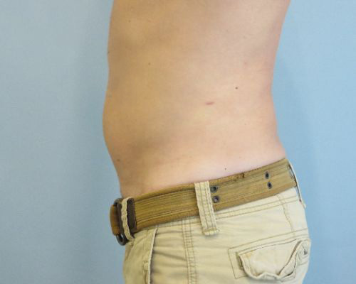 Smart Liposuction Before & After case 1