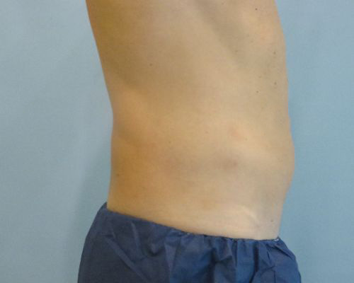 Smart Liposuction Before & After case 1