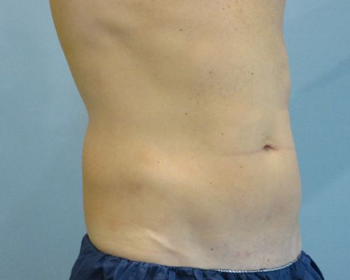 Smart Liposuction Before & After case 1