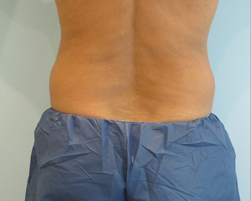 Smart Liposuction Before & After case 2