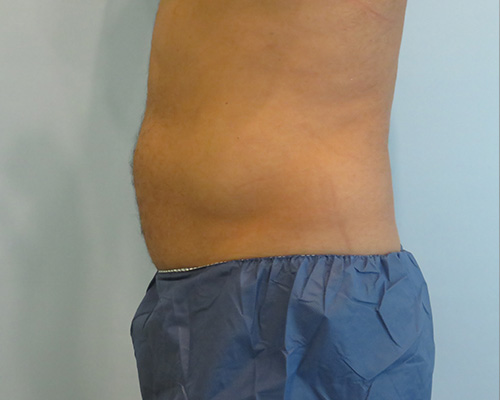 Smart Liposuction Before & After case 2