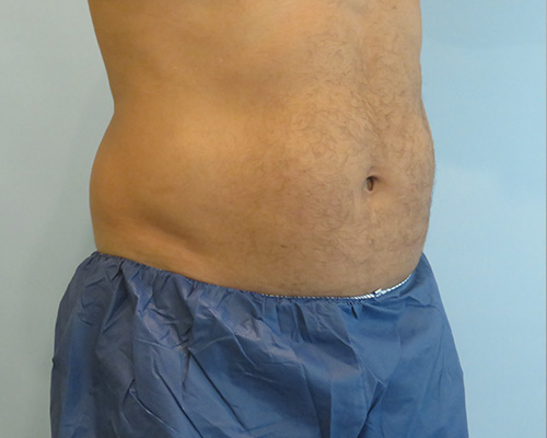 Smart Liposuction Before & After case 2