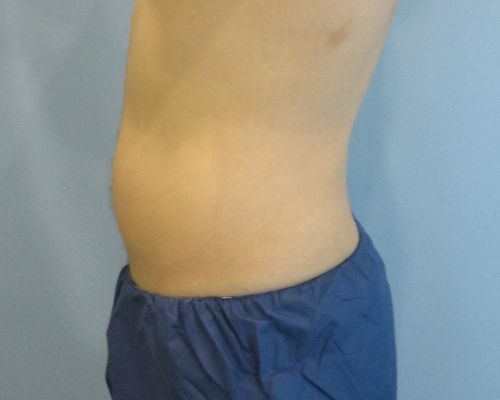 Smart Liposuction Before & After case 3
