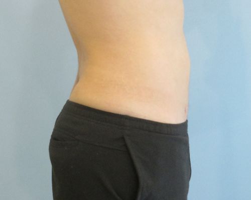 Smart Liposuction Before & After case 3