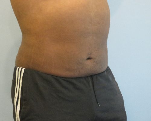 Smart Liposuction Before & After Case 4