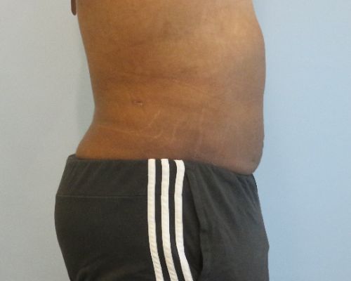 Smart Liposuction Before & After Case 4