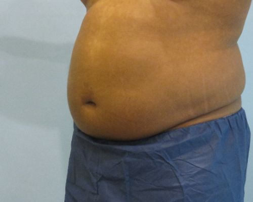 Smart Liposuction Before & After Case 4