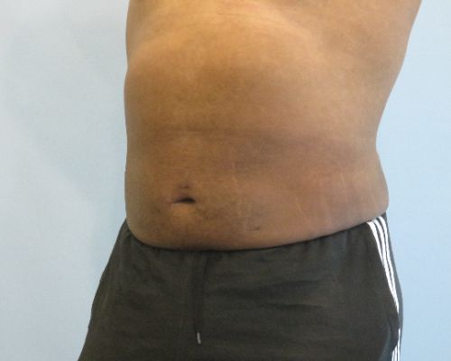 Smart Liposuction | Liposuction Before and After Case 4