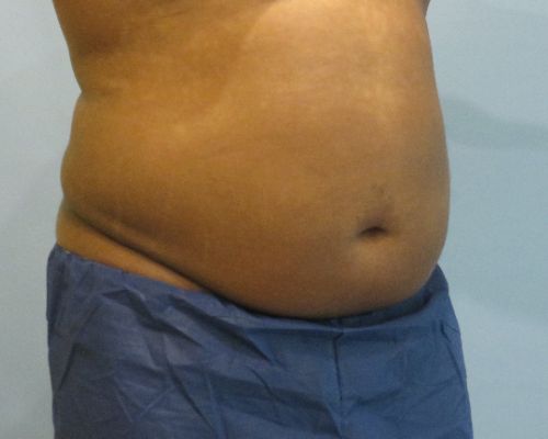 Smart Liposuction | Liposuction Before and After Case 4