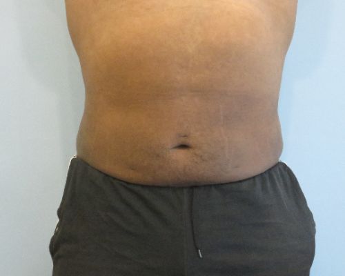 Smart Liposuction | Liposuction Before and After Case 4