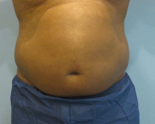 Smart Liposuction | Liposuction Before and After Case 4
