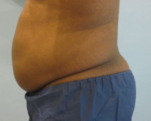 Smart Liposuction | Liposuction Before and After Case 4
